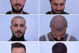 Siverek saç ekim merkezi