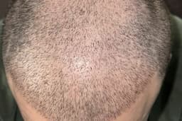 Saç Ekimi - Hair Transplant