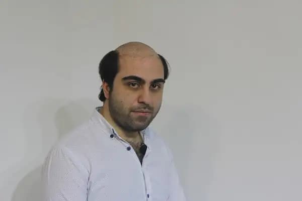 saç protez merkezi - Saç Yenileme Hizmeti - İstanbul Şişli
