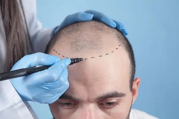 İstanbul Saç Ekim Merkezi - Mt Hair Clinic - Saç Transplantasyonu Kliniği - İstanbul Bağcılar