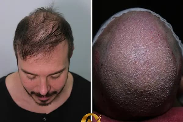 AVRUPA SAÇ EKİMİ - AVRUPA HAİR TRANSPLANT.|Greffe de Cheveux Turquie | Trasplante Capilar Turquia | Пересадка Волос в Турции - Saç Transplantasyonu Kliniği - İstanbul Avcılar