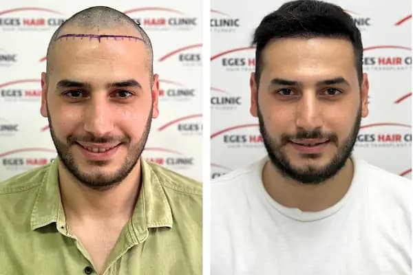 Bayraklı Saç Ekim Merkezi - İzmir Eges Hair Transplant - Güzellik Salonu - İzmir Bayraklı