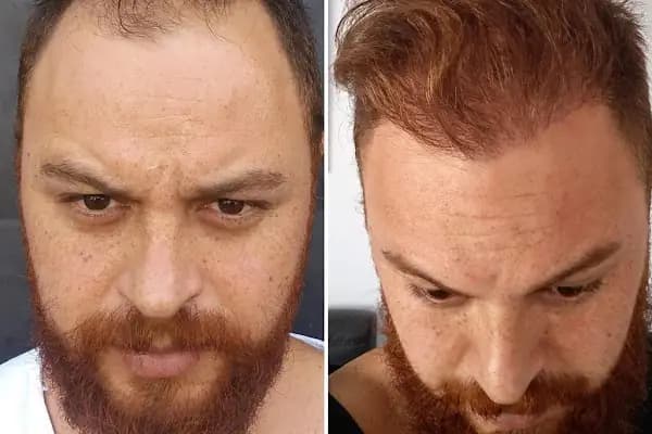 Erzurum Saç Ekim Merkezi Saç PRP`si | Altınsoy Hair Clinic - Estetik Cerrahi Kliniği - Erzurum Palandöken