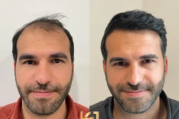 hair of diyarbakır - Saç Transplantasyonu Kliniği - Diyarbakır Kayapınar