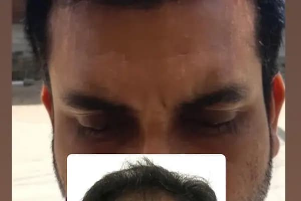 İzmir Saç Ekimi | İzmir Hair Transplantation | Serena Polikliniği | İzmir Kaş Ekimi - Saç Transplantasyonu Kliniği - İzmir Aliağa
