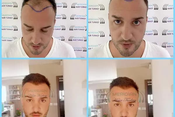 Meridian Hair Turkey - Saç Transplantasyonu Kliniği - İstanbul Esenyurt