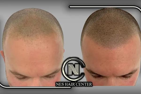 Nes Hair Center - Saç Transplantasyonu Kliniği - Ankara Çankaya