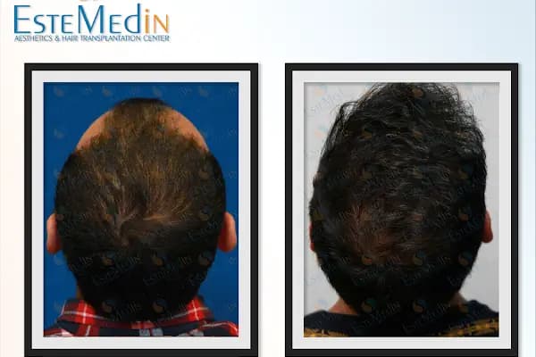 EMPCLINICS Emphair Hair Transplant, Aesthetic Plastic Surgery, Dental Treatments, Men's Health - Estetik Cerrahi Kliniği - İstanbul Bahçelievler