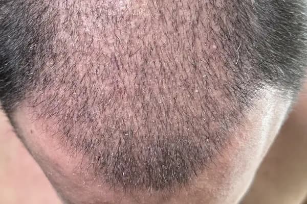 DK Klinik (Dermatology and Hair Transplant Antalya) - Dermatolog - Antalya Akseki
