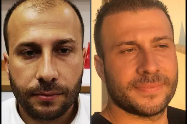 Esste Moda Hair - Saç Transplantasyonu Kliniği - Adana Seyhan
