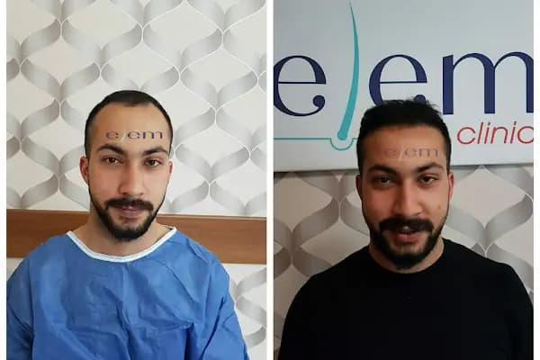 Gaziantep Saç Ekim&amp;Protez - Fue Estetik - Estetik Cerrah - Gaziantep Yavuzeli