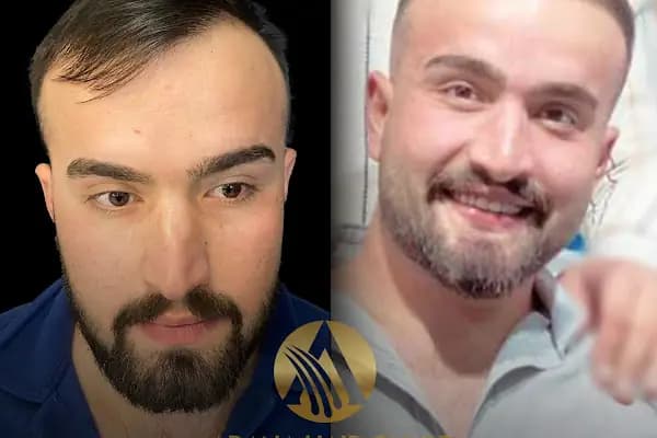 Adana Hair Clinic - Hair Transplant in Adana - Saç Transplantasyonu Kliniği - Adana Karaisalı