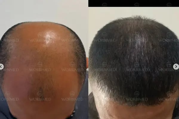 Worbimed | Hair Transplant Turkey Istanbul | Eyebrow Transplant | Beard Transplant - Resim 15