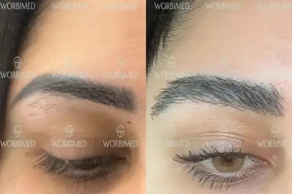 Worbimed | Hair Transplant Turkey Istanbul | Eyebrow Transplant | Beard Transplant - Resim 16
