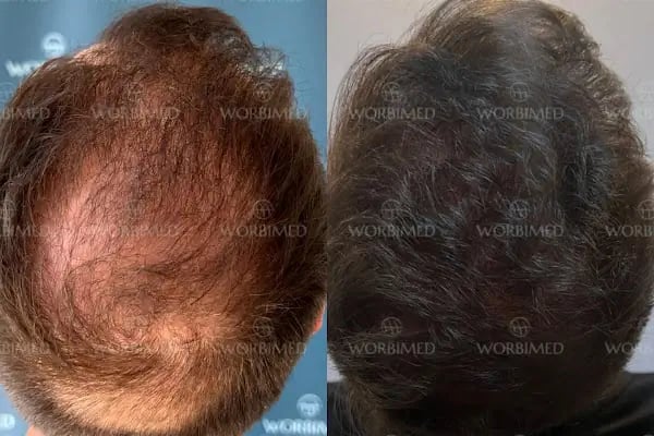 Worbimed | Hair Transplant Turkey Istanbul | Eyebrow Transplant | Beard Transplant - Resim 9