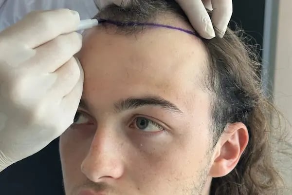 Worbimed | Hair Transplant Turkey Istanbul | Eyebrow Transplant | Beard Transplant - Resim 19