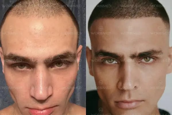 Worbimed | Hair Transplant Turkey Istanbul | Eyebrow Transplant | Beard Transplant - Resim 13