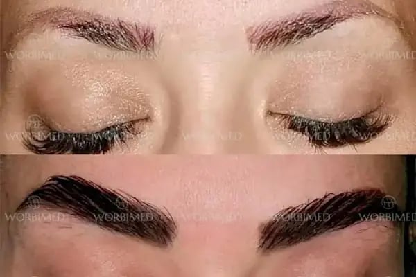 Worbimed | Hair Transplant Turkey Istanbul | Eyebrow Transplant | Beard Transplant - Resim 7