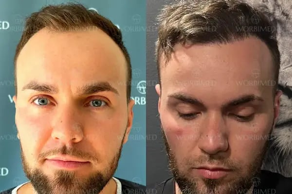 Worbimed | Hair Transplant Turkey Istanbul | Eyebrow Transplant | Beard Transplant - Resim 10