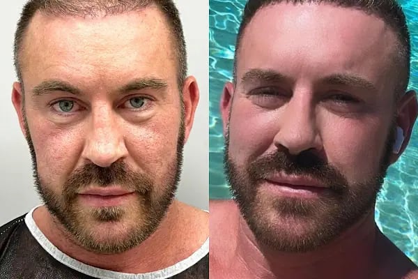 Worbimed | Hair Transplant Turkey Istanbul | Eyebrow Transplant | Beard Transplant - Resim 12