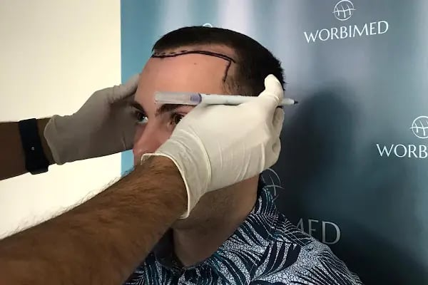 Worbimed | Hair Transplant Turkey Istanbul | Eyebrow Transplant | Beard Transplant - Resim 6