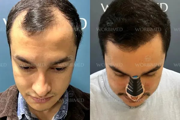 Worbimed | Hair Transplant Turkey Istanbul | Eyebrow Transplant | Beard Transplant - Resim 8