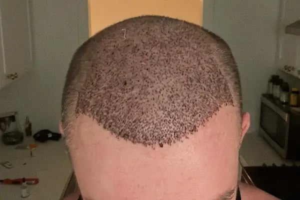 Worbimed | Hair Transplant Turkey Istanbul | Eyebrow Transplant | Beard Transplant - Resim 17