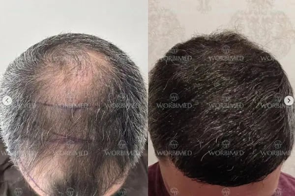 Worbimed | Hair Transplant Turkey Istanbul | Eyebrow Transplant | Beard Transplant - Resim 14