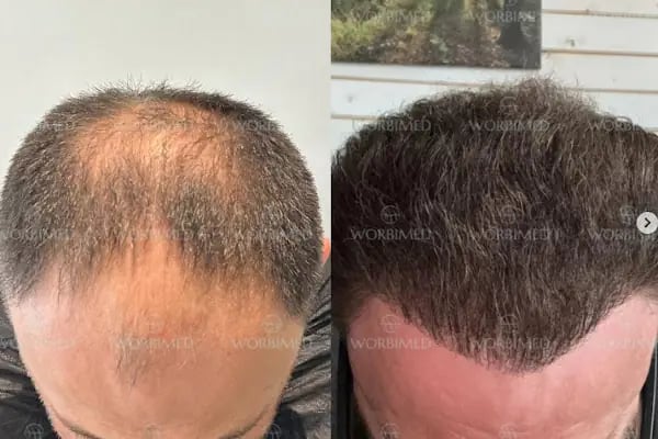Worbimed | Hair Transplant Turkey Istanbul | Eyebrow Transplant | Beard Transplant - Resim 18