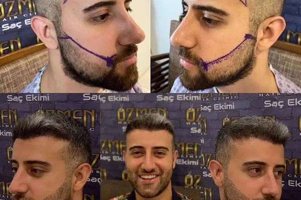 SU HASTANESİ /Saç Ekim - Resim 5