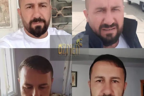SU HASTANESİ /Saç Ekim - Resim 6