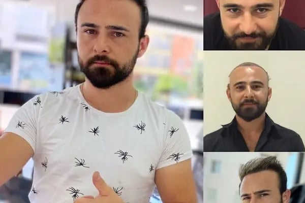 SU HASTANESİ /Saç Ekim - Resim 1