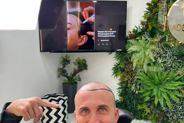 Henfa Clinic - Hair Transplant - Resim 9