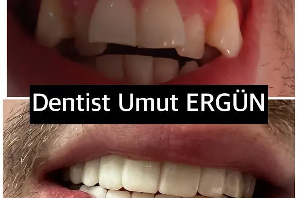 Dentist Alanya , Diş Hekimi Umut ERGÜN - Resim 12