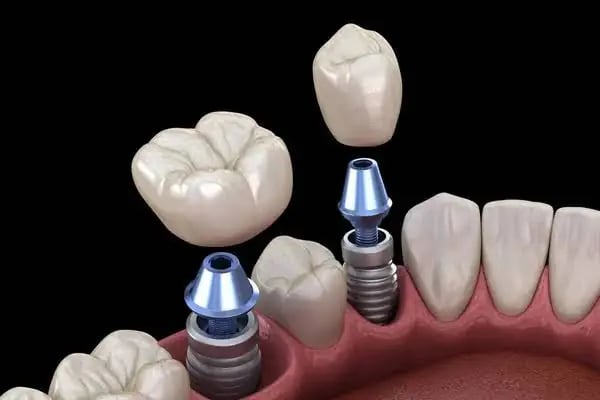 BAĞCILAR ÖZEL AİLE TIP MERKEZİ DİŞ KLİNİĞİ - Resim 7
