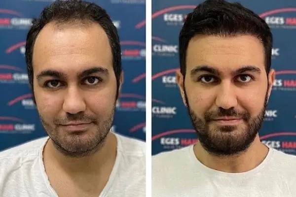 Aydın Saç Ekim Merkezi Eges Hair Transplant Clinic - Resim 18