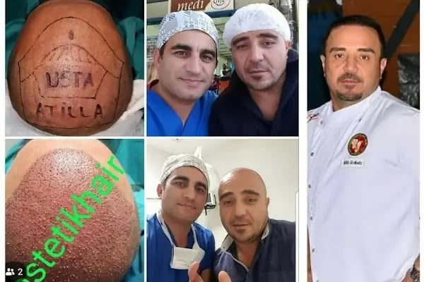 ESTETİK HAİR SAÇ EKİMİ - Resim 18