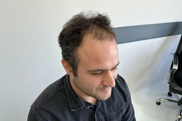 İbrahim Erayhan-Saç Ekimi-Bursa Tıp Merkezi - Hairtransplant Clinic - Resim 8