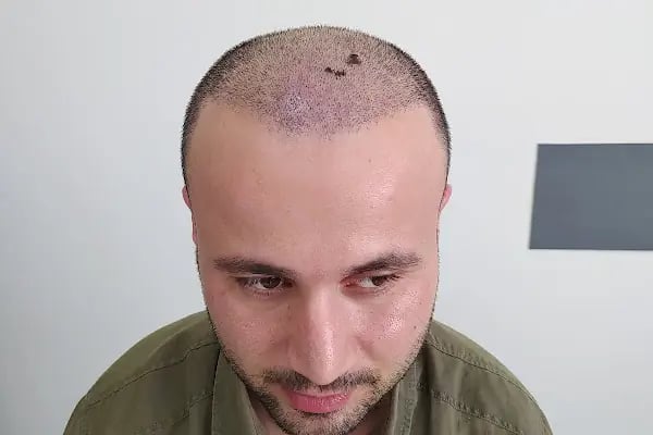 İbrahim Erayhan-Saç Ekimi-Bursa Tıp Merkezi - Hairtransplant Clinic - Resim 11