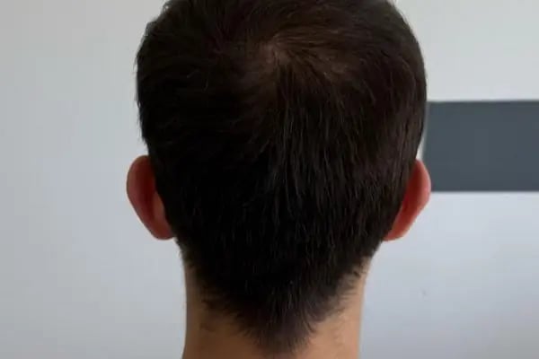 İbrahim Erayhan-Saç Ekimi-Bursa Tıp Merkezi - Hairtransplant Clinic - Resim 14