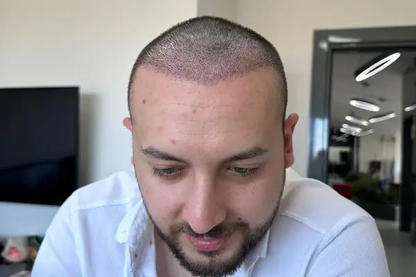 İbrahim Erayhan-Saç Ekimi-Bursa Tıp Merkezi - Hairtransplant Clinic - Resim 13