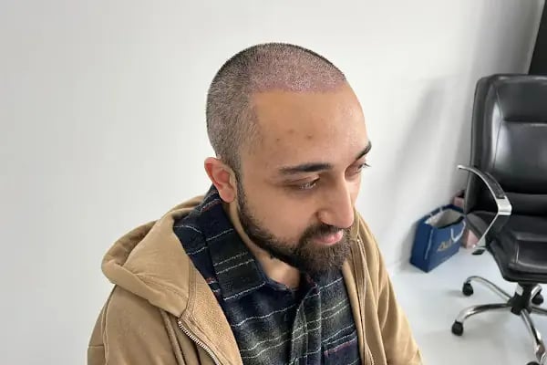 İbrahim Erayhan-Saç Ekimi-Bursa Tıp Merkezi - Hairtransplant Clinic - Resim 12