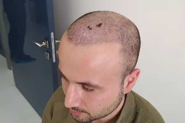 İbrahim Erayhan-Saç Ekimi-Bursa Tıp Merkezi - Hairtransplant Clinic - Resim 17