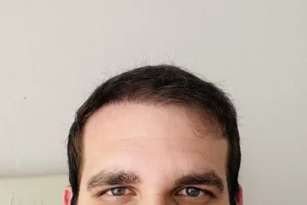 İbrahim Erayhan-Saç Ekimi-Bursa Tıp Merkezi - Hairtransplant Clinic - Resim 7