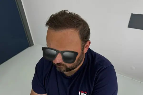 İbrahim Erayhan-Saç Ekimi-Bursa Tıp Merkezi - Hairtransplant Clinic - Resim 16