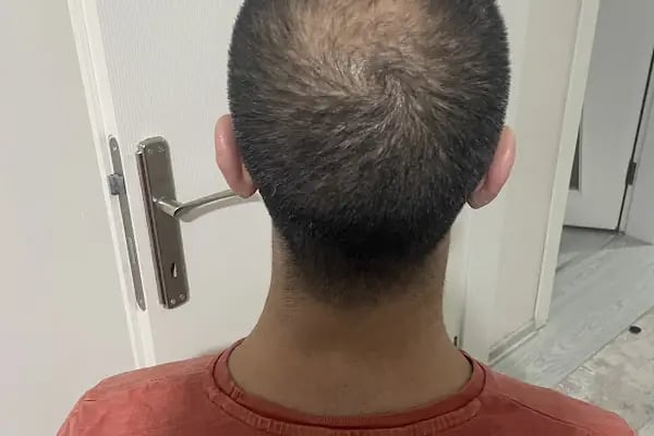 İbrahim Erayhan-Saç Ekimi-Bursa Tıp Merkezi - Hairtransplant Clinic - Resim 10