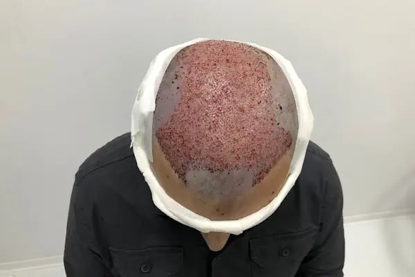 İbrahim Erayhan-Saç Ekimi-Bursa Tıp Merkezi - Hairtransplant Clinic - Resim 4