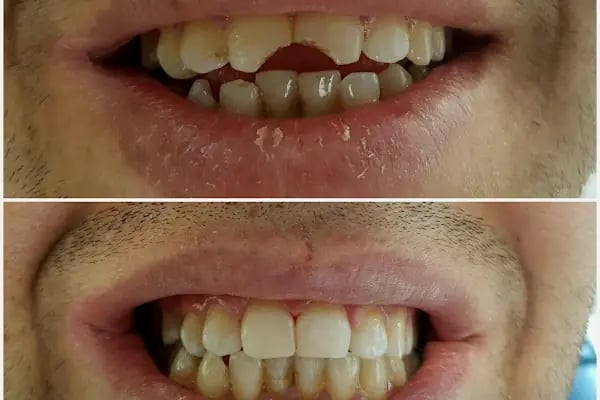 Dentium Selçuklu - Konya, Diş Hekimi, İmplant, Zirkonyum, Gülüş Tasarımı, Estetik, Ortodonti, Çocuk, Gece Açık Dişçi, Acil - Resim 6