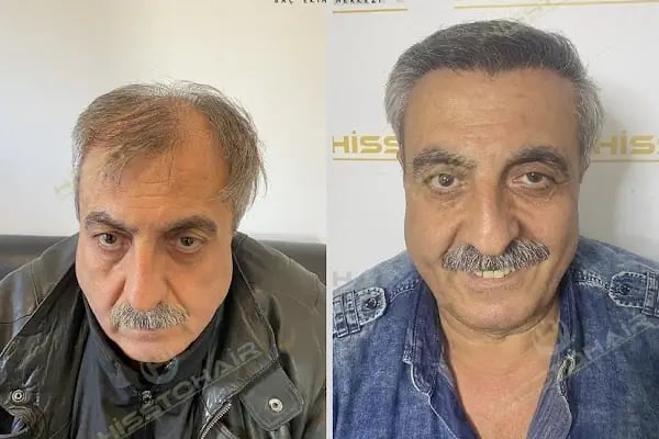 İzmir Saç Ekimi Merkezi - Hisstohair | Fue saç ekimi | PRP ve Mezoterapi | Sakal ekimi | Kaş ekimi - Resim 8
