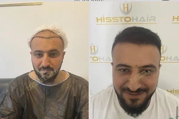 İzmir Saç Ekimi Merkezi - Hisstohair | Fue saç ekimi | PRP ve Mezoterapi | Sakal ekimi | Kaş ekimi - Resim 7